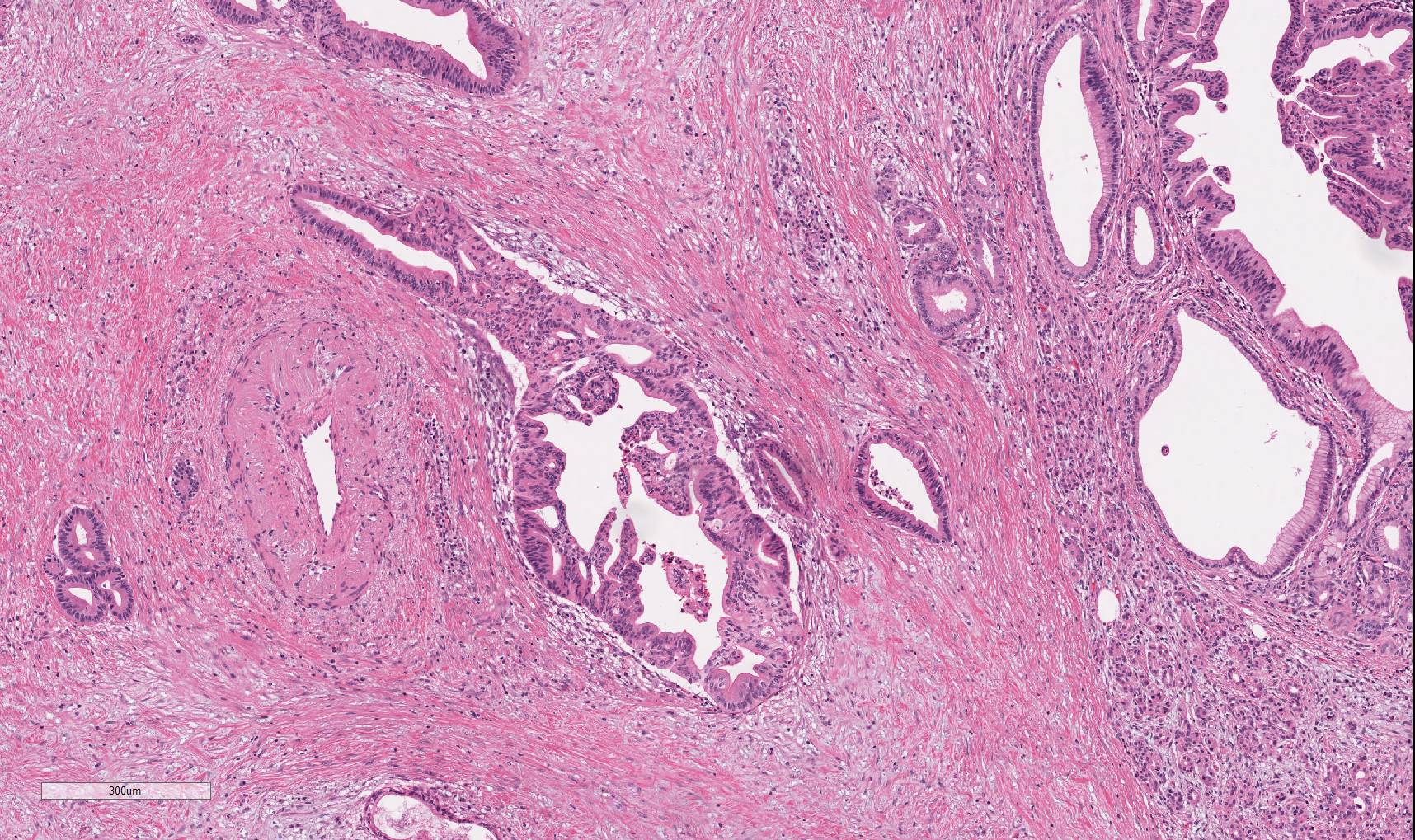 microscopic image of pancreatic cancer