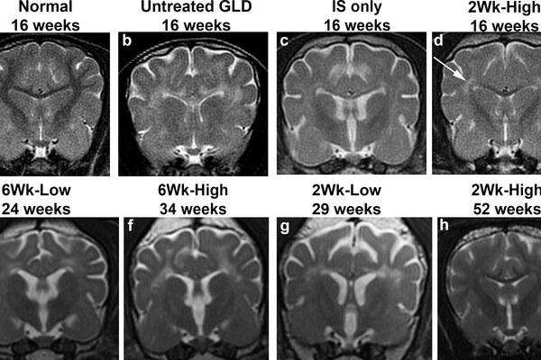 Sequence of 8 MRI images showing treated versus untreated brains from 16 to 52 weeks