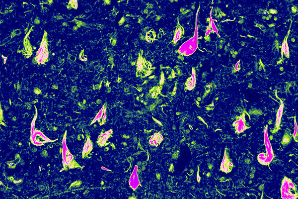 Microscopic view of abnormal neurofibrillary tangles.