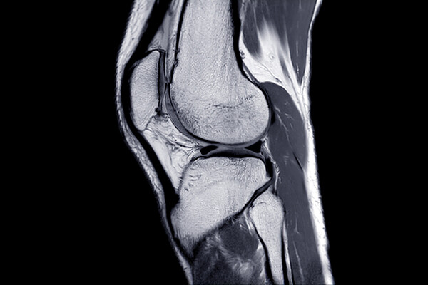 x-ray of a knee joint and cartilage