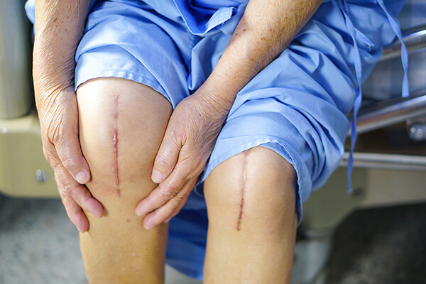 Person in hospital scrubs seated with pant legs rolled up to expose knee surgery scars.