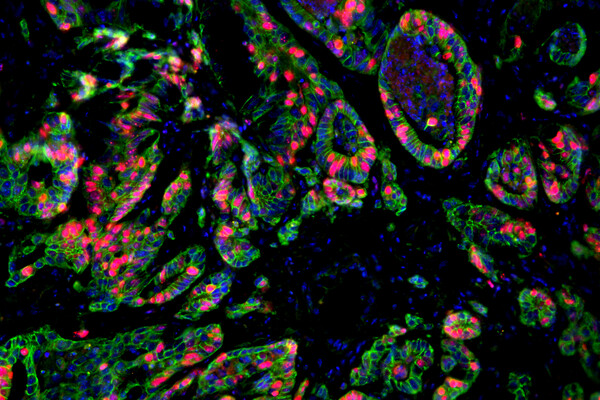Fluorescent microscopy of colon cancer cells..