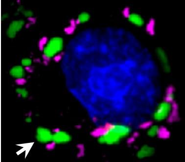In cells under duress, stress granules (in magenta) form outside of the nucleus (in blue). TDP-43 protein in green (arrow) that cannot bind to PolyADP ribose (PAR) builds up in large clumps distinct from stress granules. (Image: Leeanne McGurk, University of Pennsylvania; Molecular Cell)