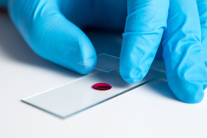 gloved-hand-with-blood-test-glass-slide