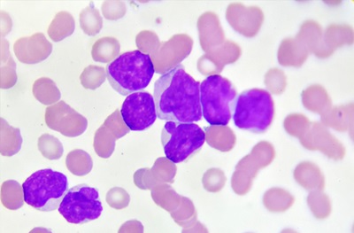 microscopic image of acute myeloid leukemia cells