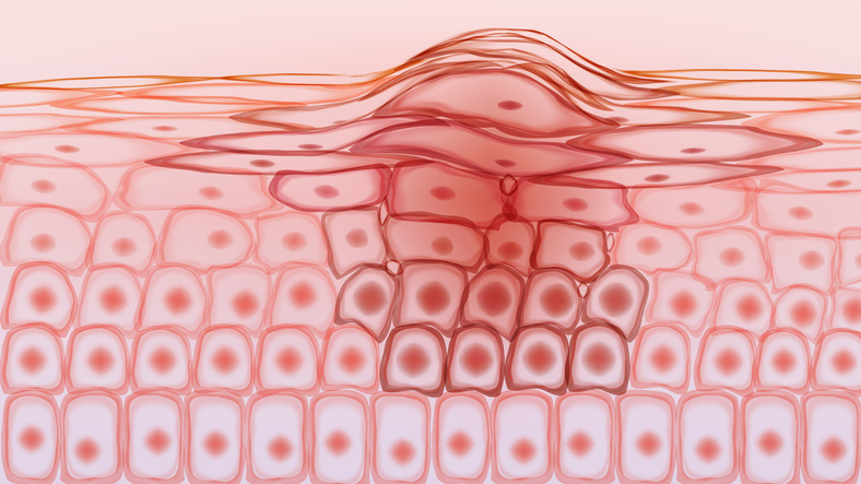 raised surface of melanoma amidst microscopic skin cells