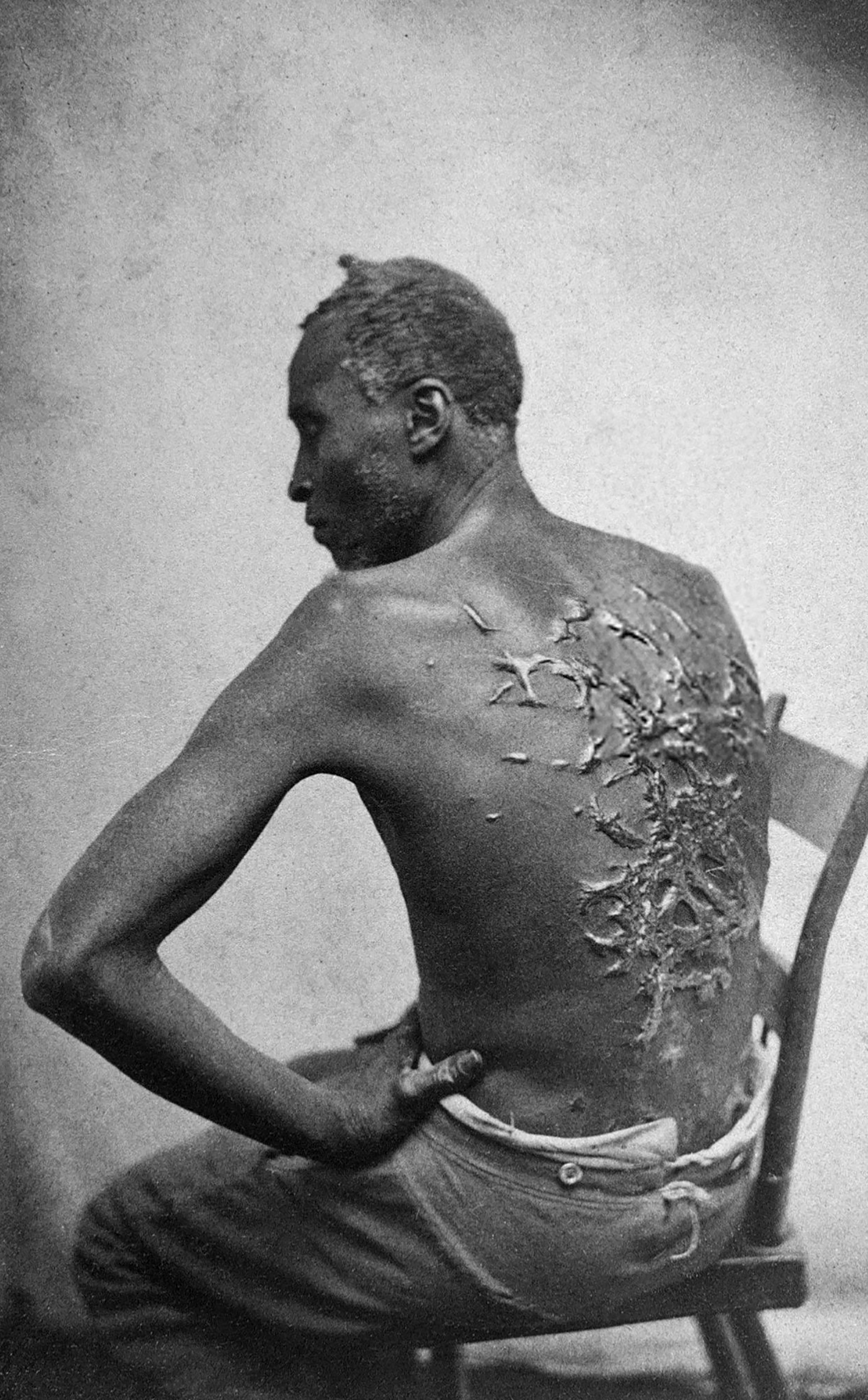 Peter or Gordon, an enslaved black man, with whip marks on his back in 1963.