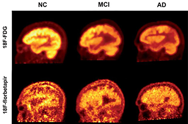Six amyloid brain scans, three on top, three below, comparing levels of amyloid in relation to presence of alzheimers