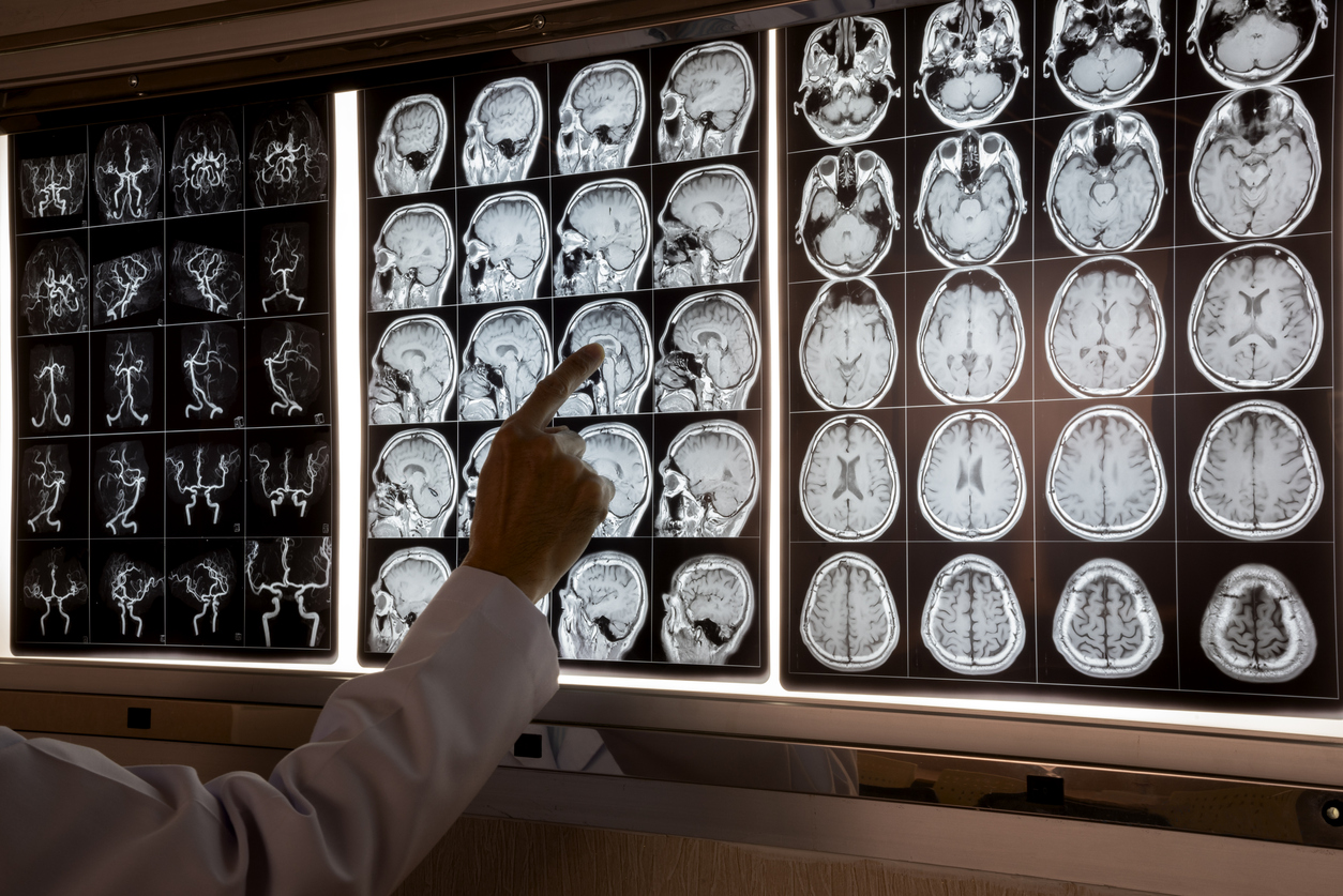 A doctor points to a middle panel of a three-panel display of MRI brain scans