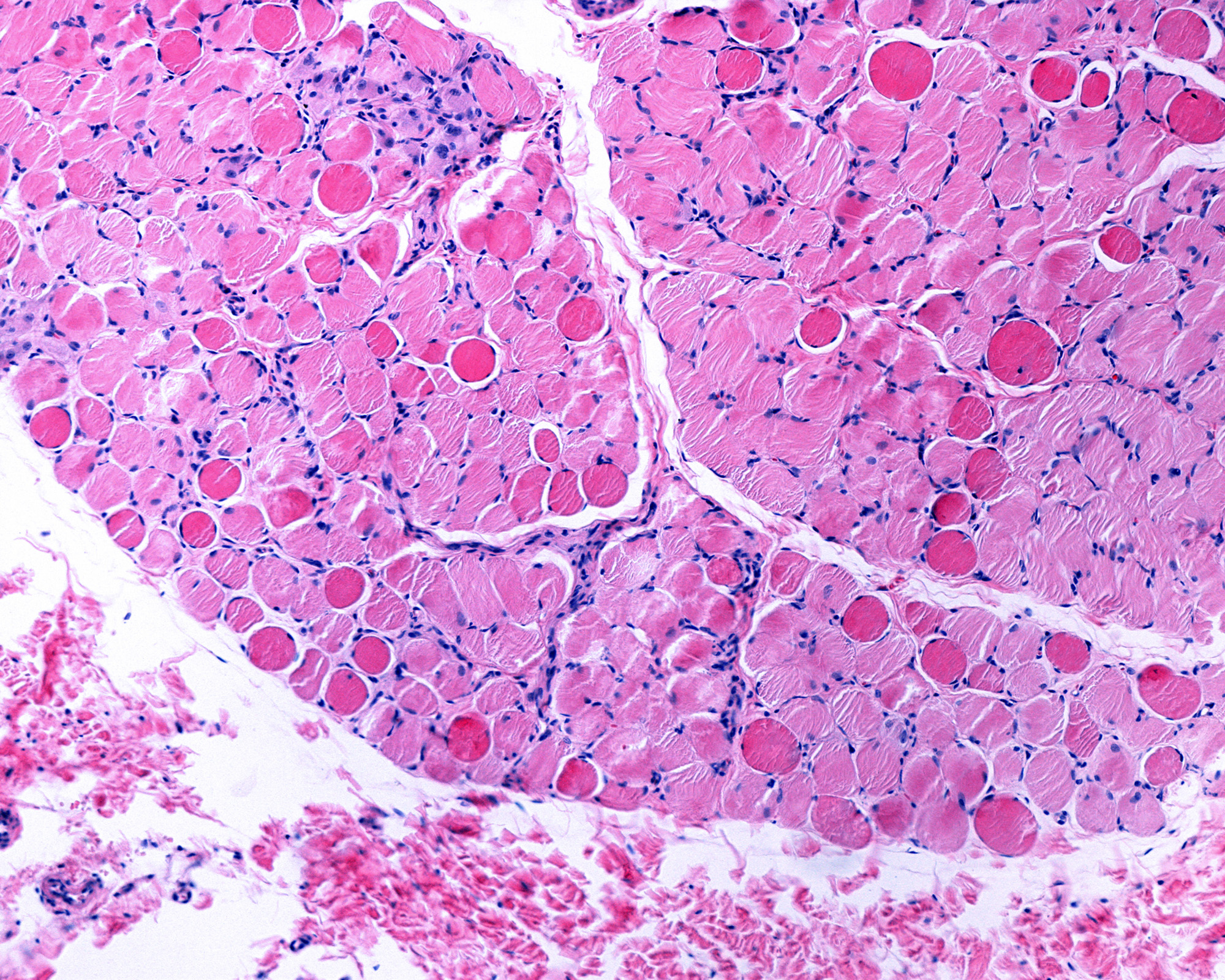 Necrotic muscle fiber Duchenne muscular dystrophy