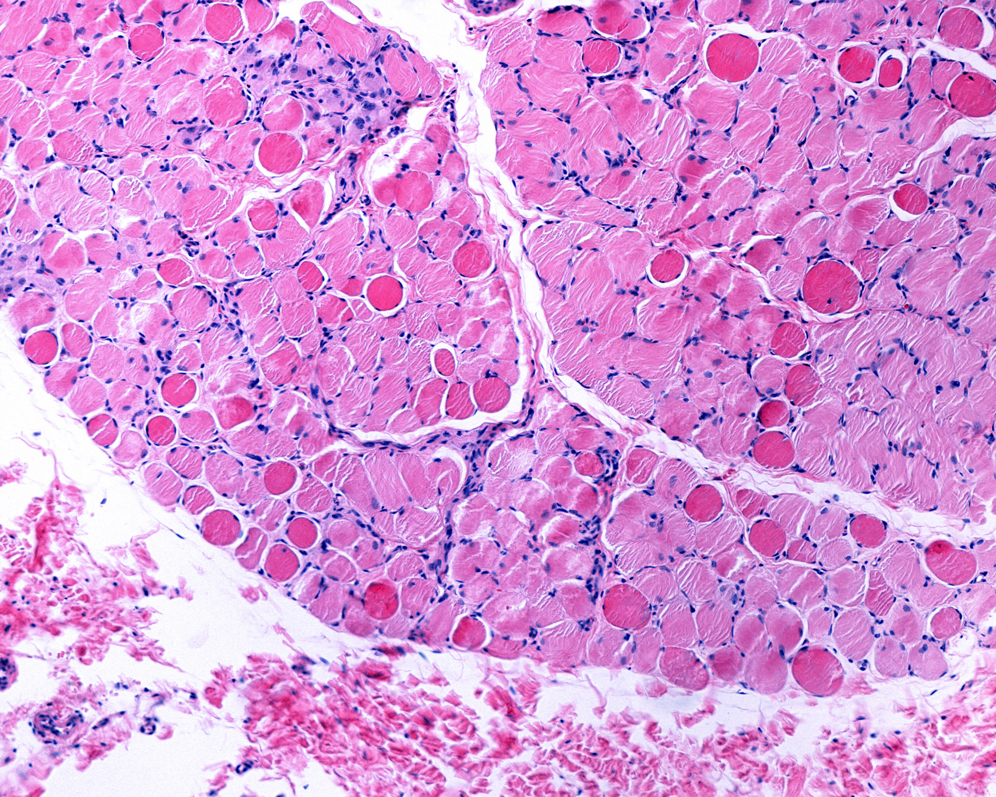 Duchenne Muscular Dystrophy Muscle