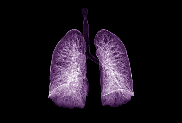 x-ray of lungs in purple