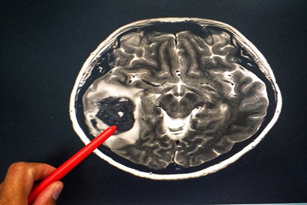 MRI scan of brain and hand with a red marker pointing at a mark on the scan.