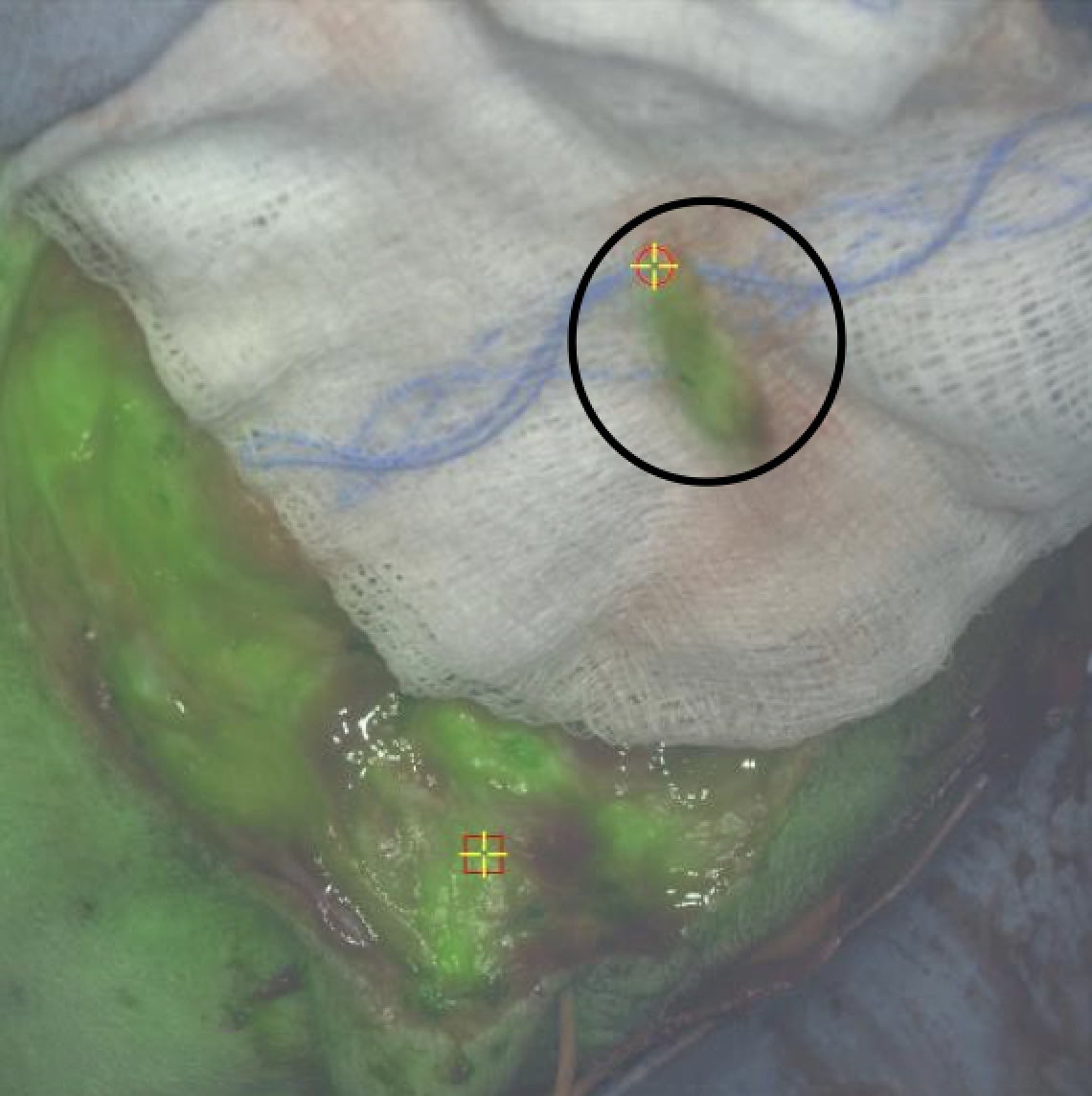 Cancer tissue labeled with dye glowing green to indicate where disease is located