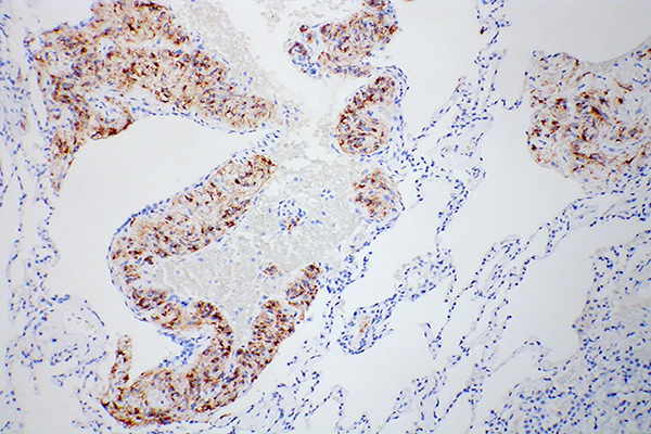 Microscopic lymphangioleiomyomatosis cells 