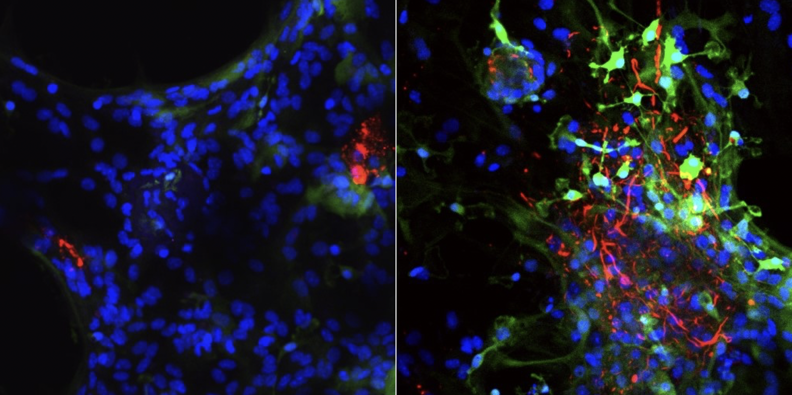 Two panels of cells affected by Parkinson's disease with fluorescent labels in shades of red, green, and blue