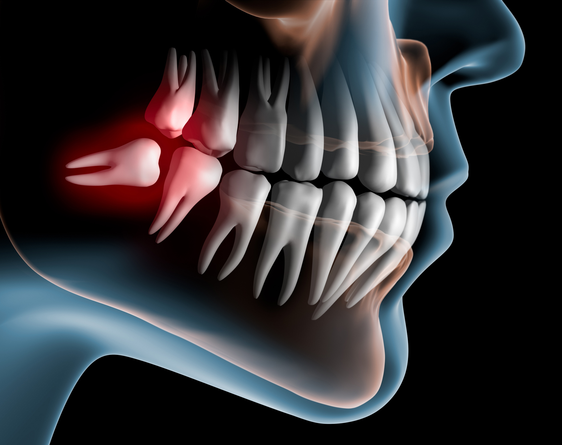 Rendering of a lengthwise wisdom tooth in the lower jaw.