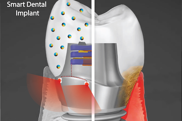 diagram of tooth with metal screw attaching it to gum with words smart dental implant