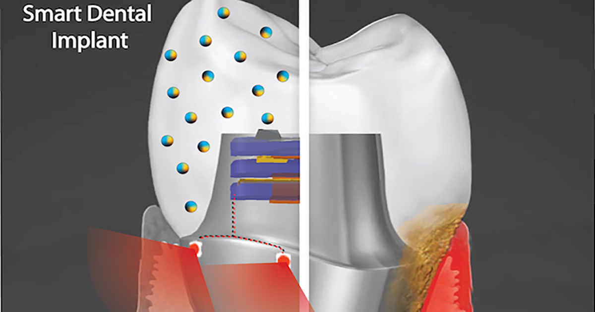 Smart dental implants Penn Today