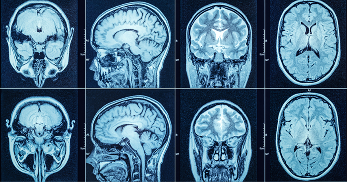 Grid of eight brain scans.