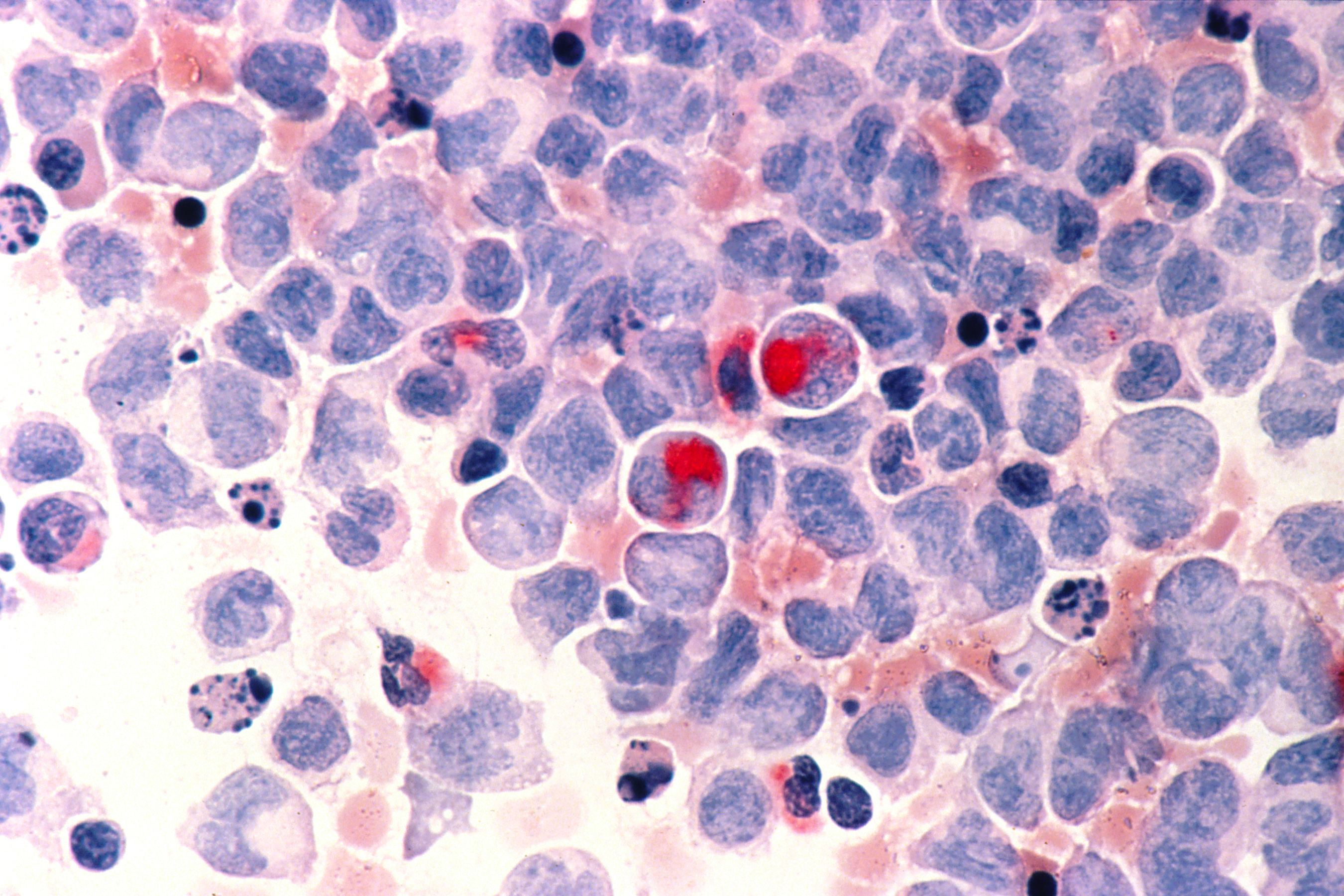 Human cells with acute myeloid leukemia