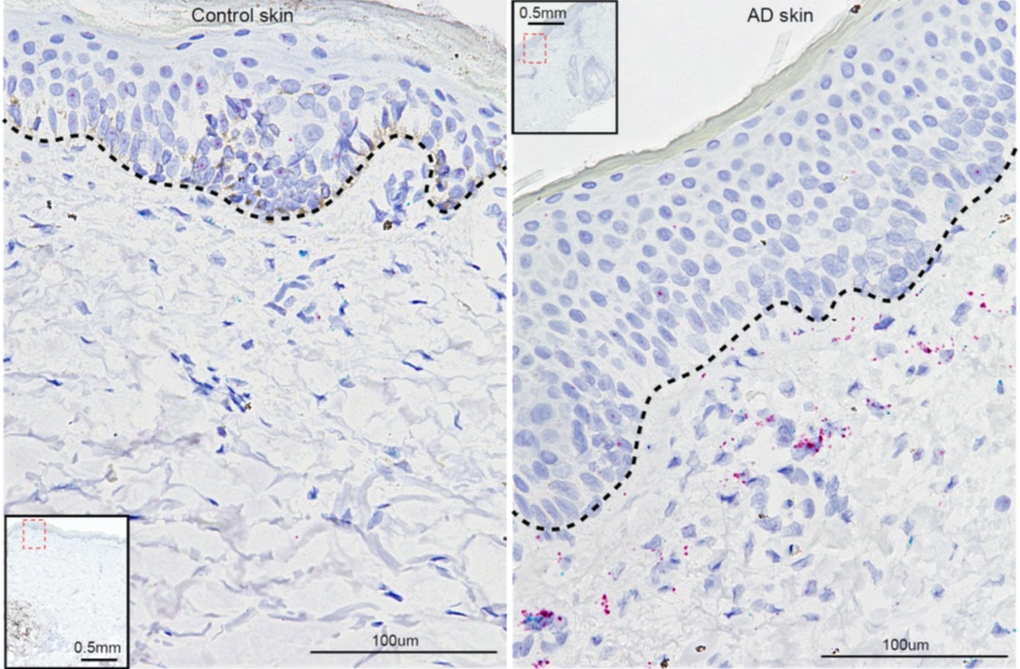 In two panels labeled "control skin" and "AD skin" stained cells show how inflammation is present in patients with atopic dermatitis