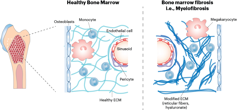Side-by-side panels showing healthy bone marrow and bone marrow fibrosis, noting the fibrous extracellular matrix and associations with immune monocytes