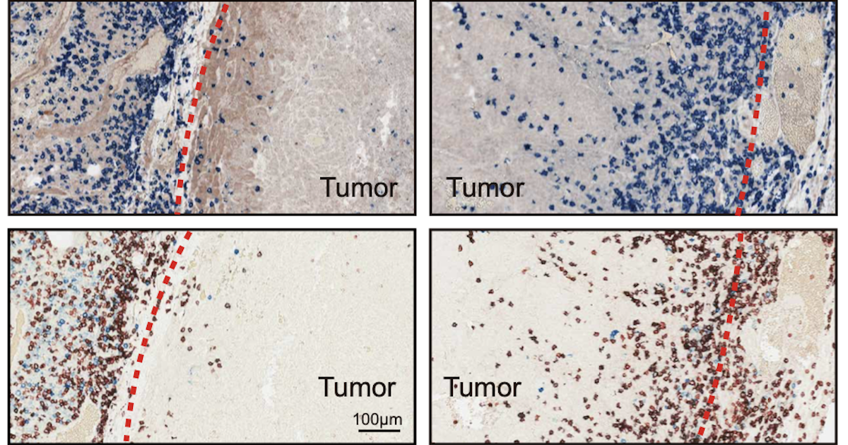 four panels labeled tumor, two of which show cells penetrating into the tumor and two show a barrier preventing cell migration