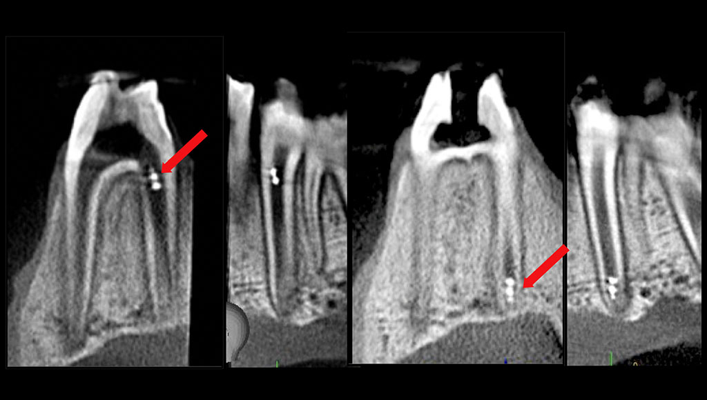 Four X-rays of a tooth with arrows indicating the something significant in the structure of the tooth.