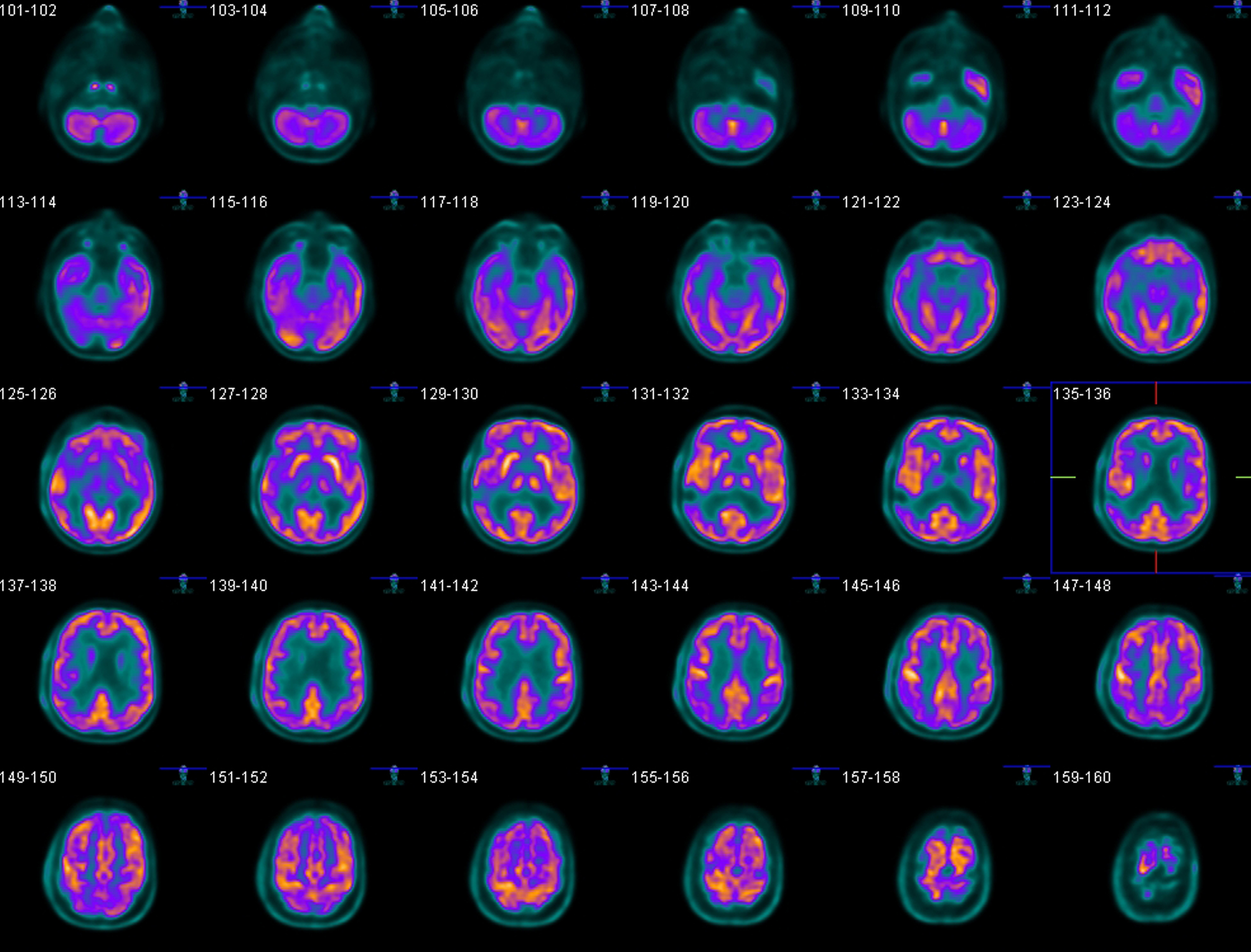 Tackling the ethical considerations of dementia research | Penn Today