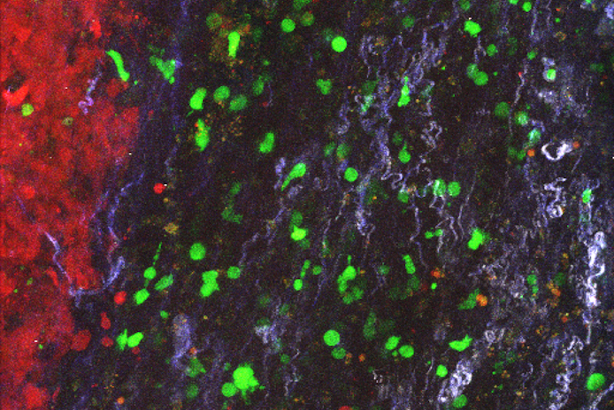 Stroma-targeting CAR T cells (green) in the stroma surrounding a solid tumor.