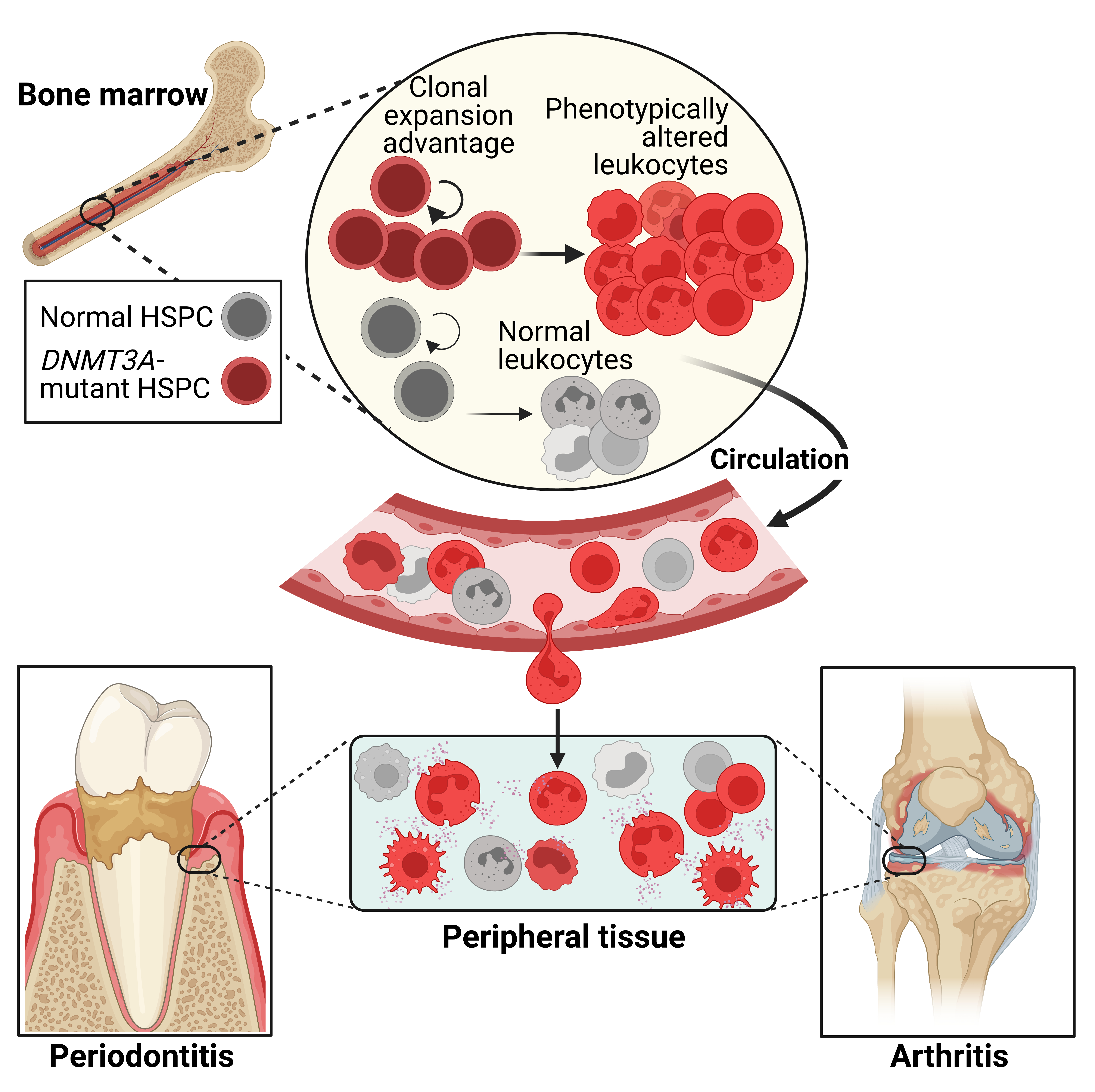 Illustration demonstrating clonal expansion of hematopoietic stem cells driving inflammatroy bone loss