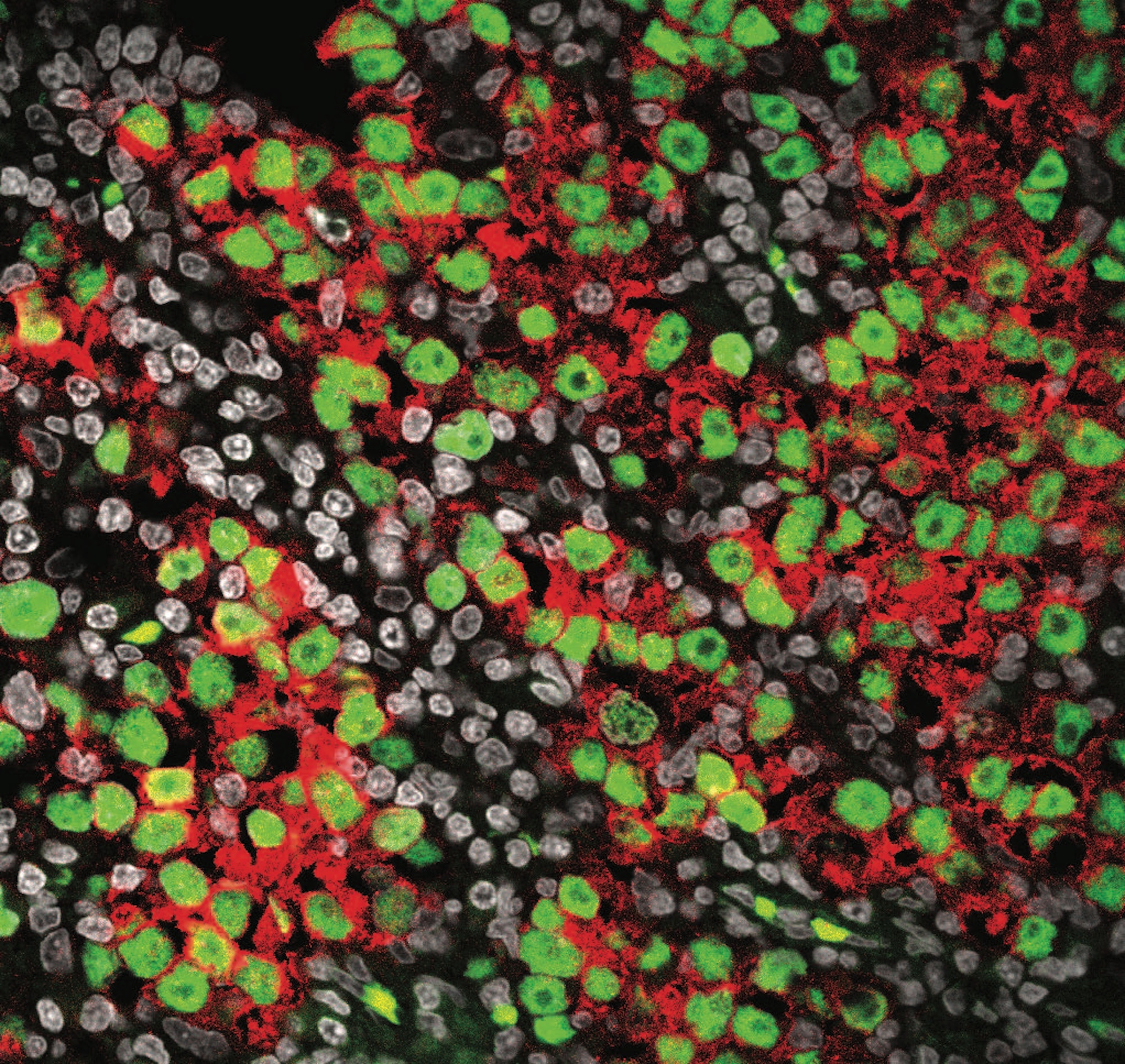 image shows a section of seminoma tissue, a type of testicular cancer. The green color indicates cells that are similar to early-stage germ cells, which are the cells that develop into sperm. The red color highlights areas with high activity of specific genes linked to cancer growth. The gray cells are the nuclei of all the cells in the tissue.