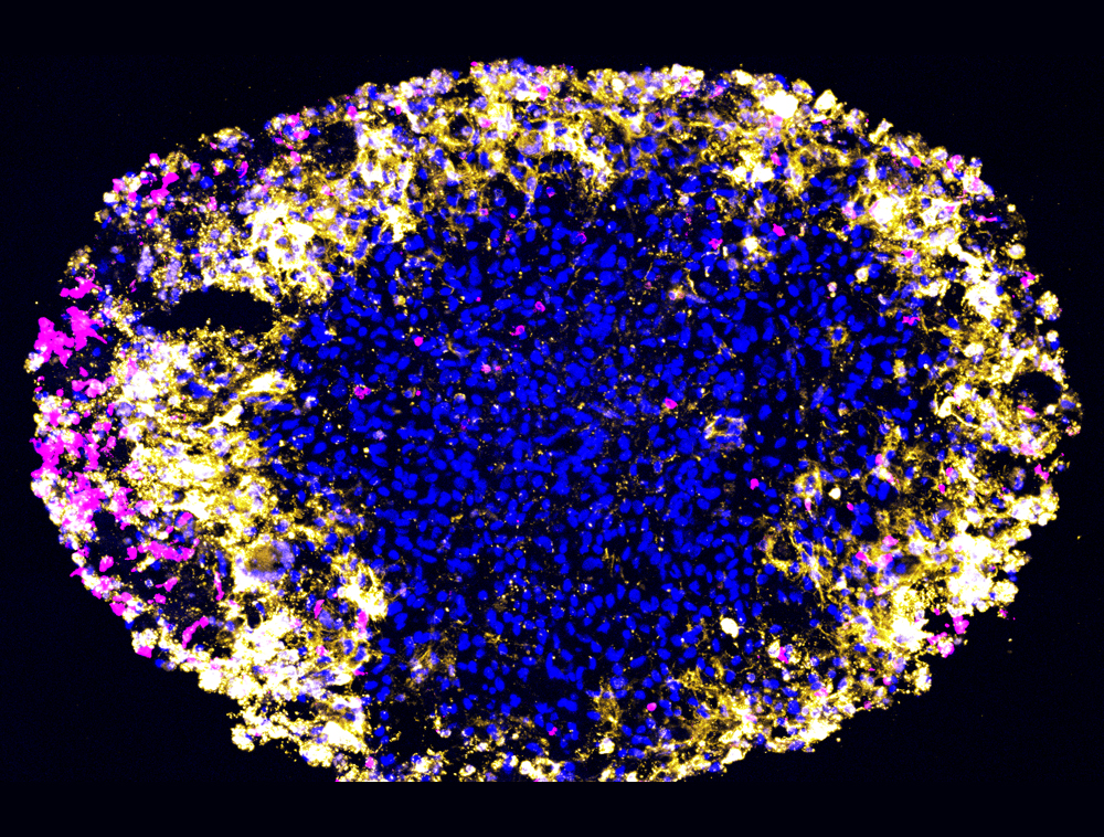 Microscopic view of a glioblastoma organoid.