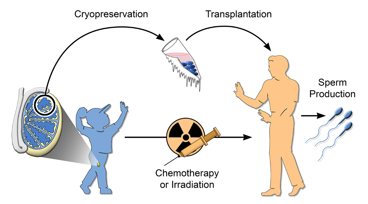 A schematic shows how testes tissue taken from a boy before chemotherapy treatment and then cryopreserved could be transplanted after adolescence and give rise to viable sperm