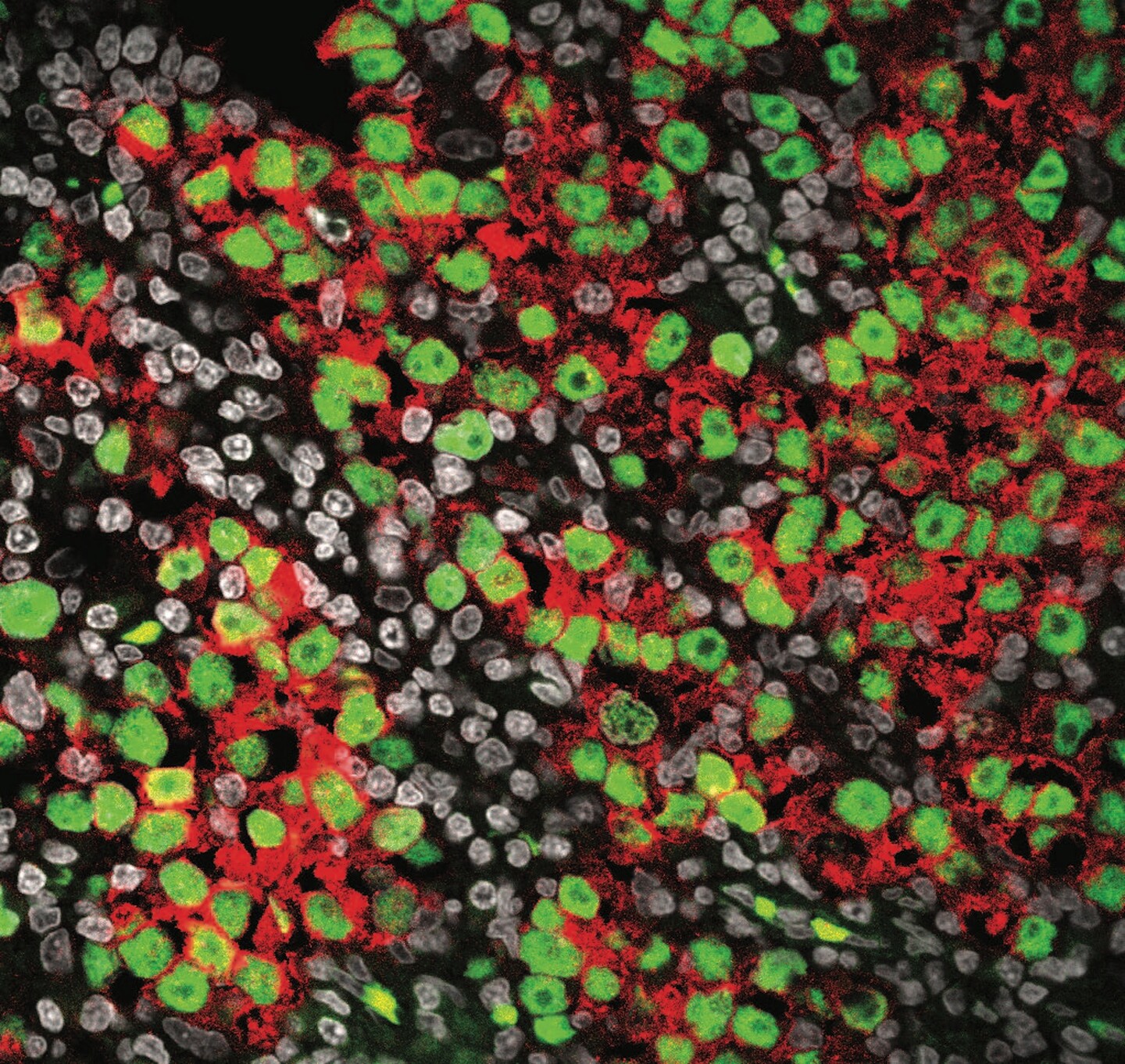 image shows a section of seminoma tissue, a type of testicular cancer. The green color indicates cells that are similar to early-stage germ cells, which are the cells that develop into sperm. The red color highlights areas with high activity of specific genes linked to cancer growth. The gray cells are the nuclei of all the cells in the tissue.