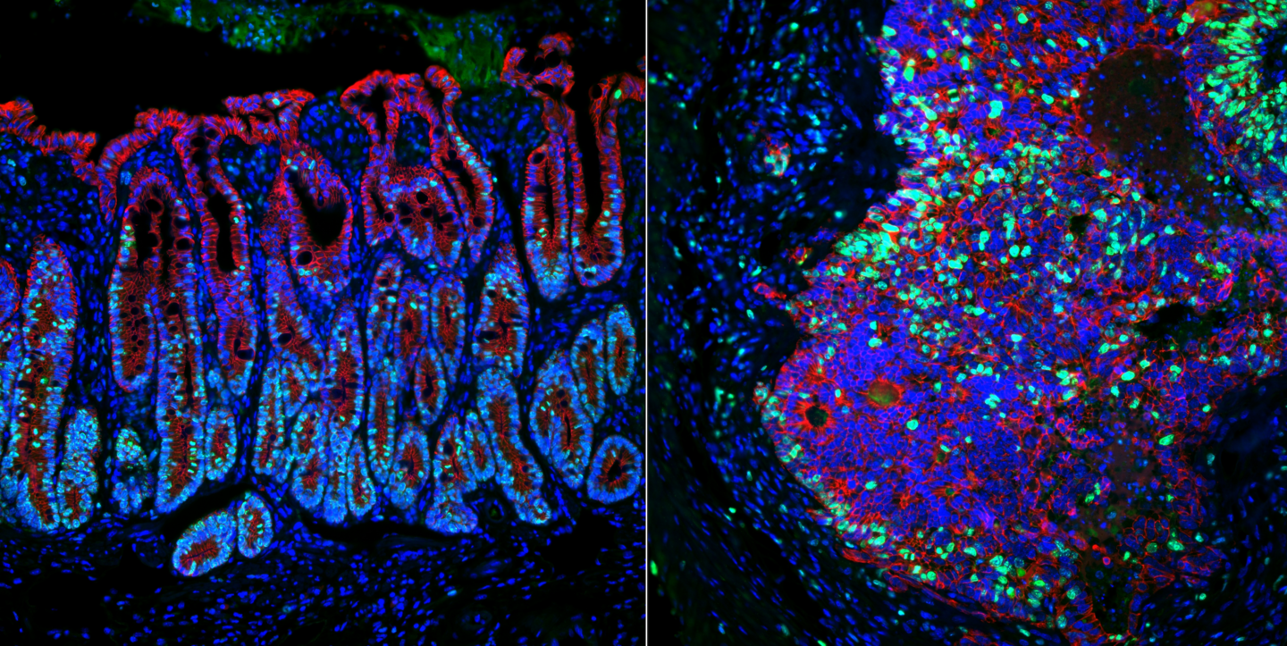 Immunofluorescent view of a normal colon on the left and a colon tumor on the right.