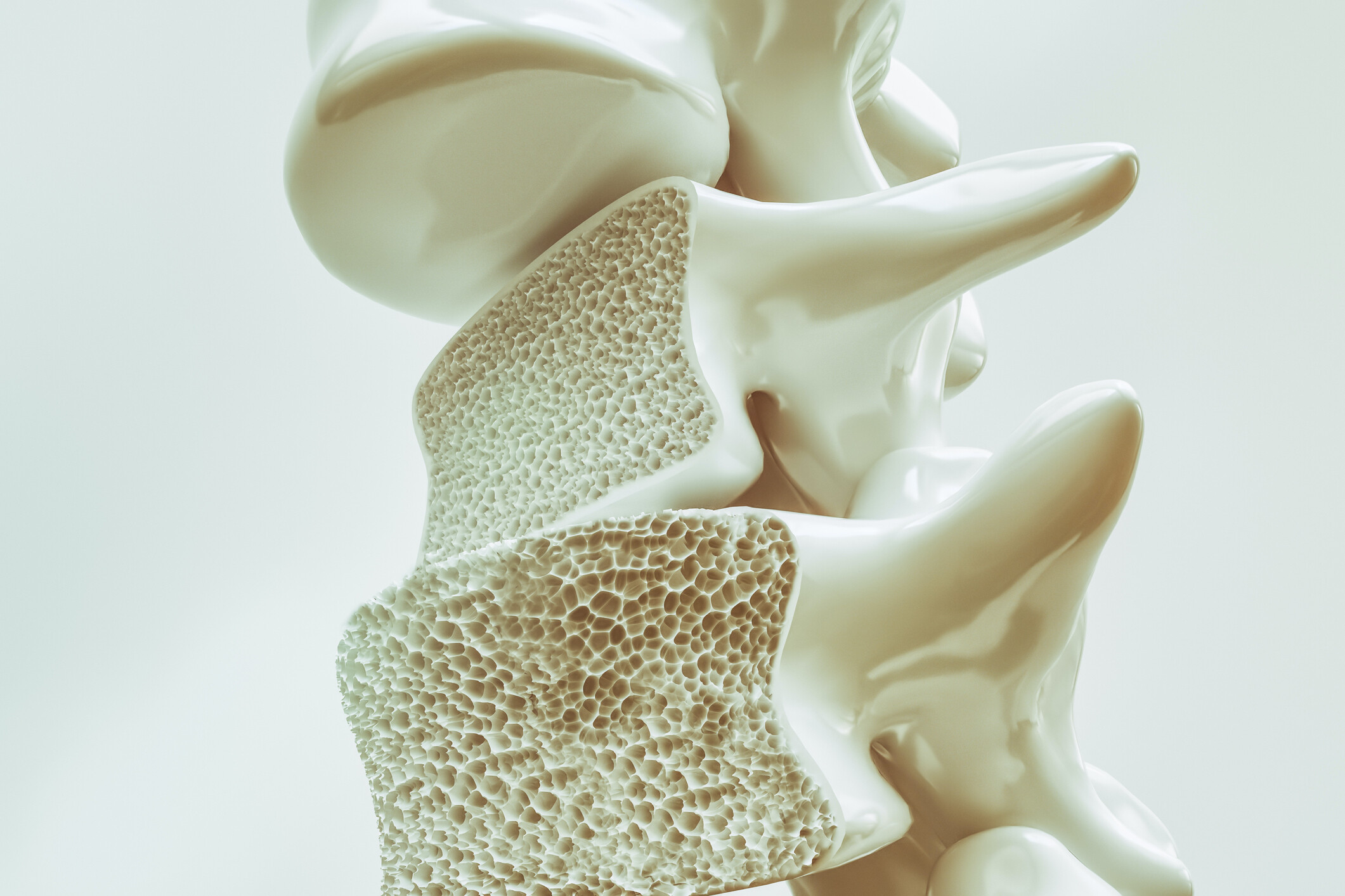model of spine showing larger holes indicative of osteoporosis