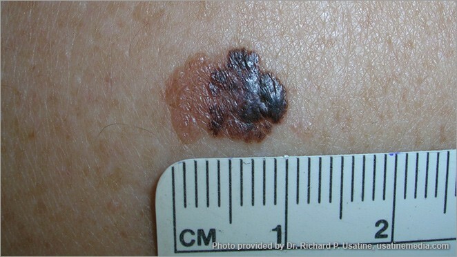 melanoma