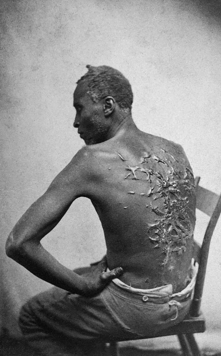 Peter or Gordon, an enslaved black man, with whip marks on his back in 1963.