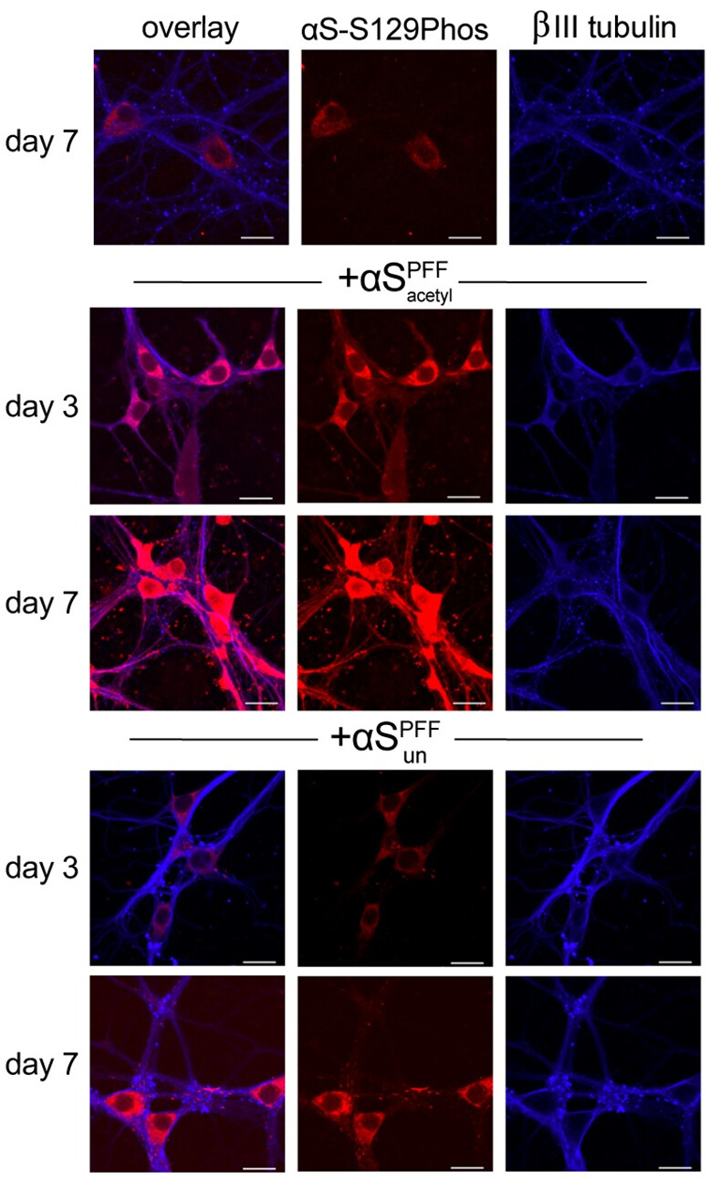 a neuron with coloration showing where alpha-synuclein aggregates form