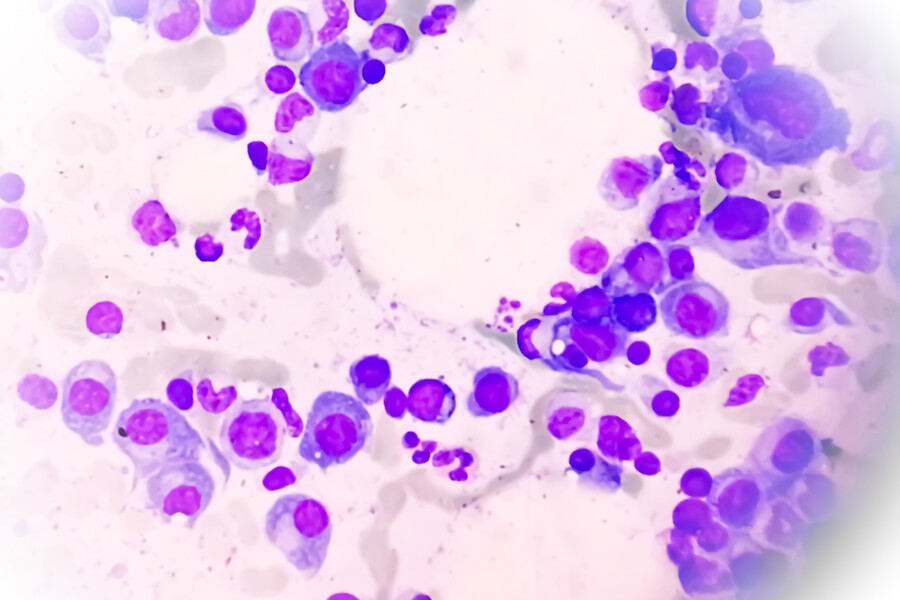 Microscopic view of bone marrow slide showing multiple myeloma, a type of bone marrow cancer.