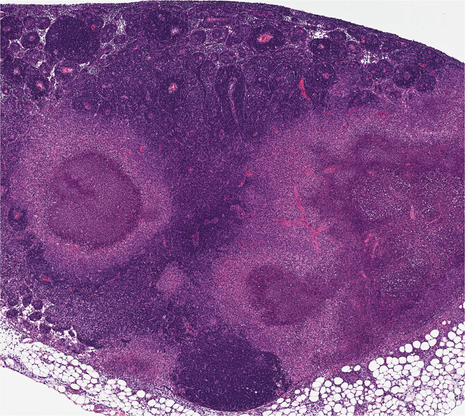 Brodsky granuloma Brodsky granuloma
