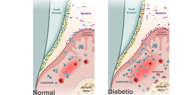 Diabetes oral microbiome