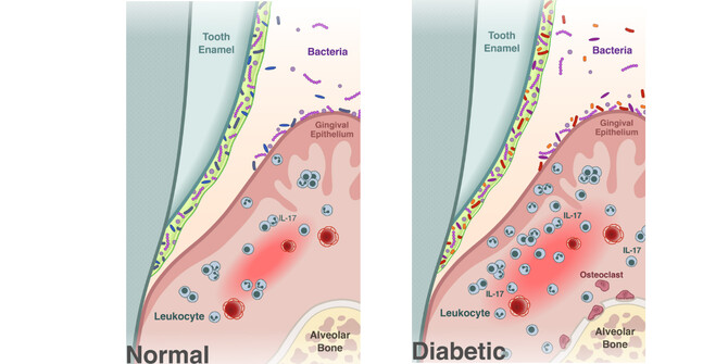 Diabetes oral microbiome Diabetes oral microbiome