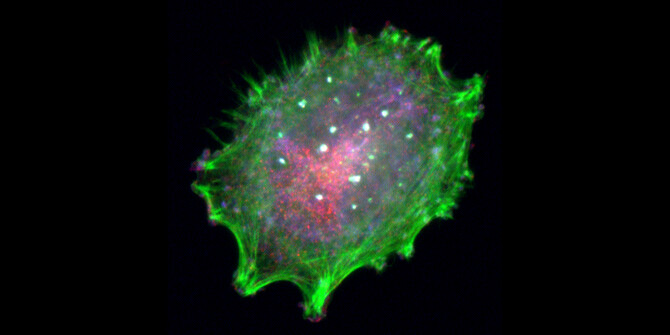 Guo melanoma Guo melanoma