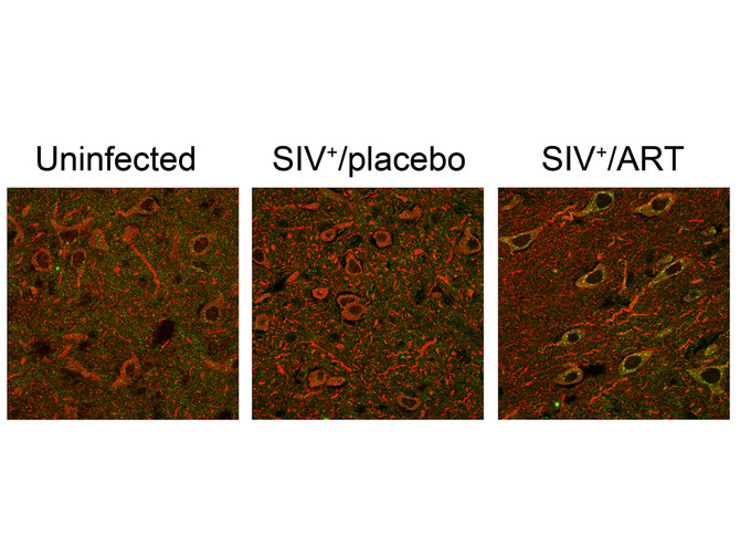HIV treatment and neurons HIV treatment and neurons