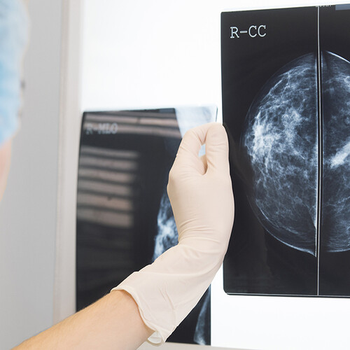 nurse in surgery outfit is holding a mammogram in front of x-ray illuminator