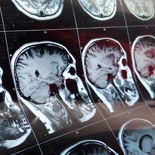 CT scan of a brain.