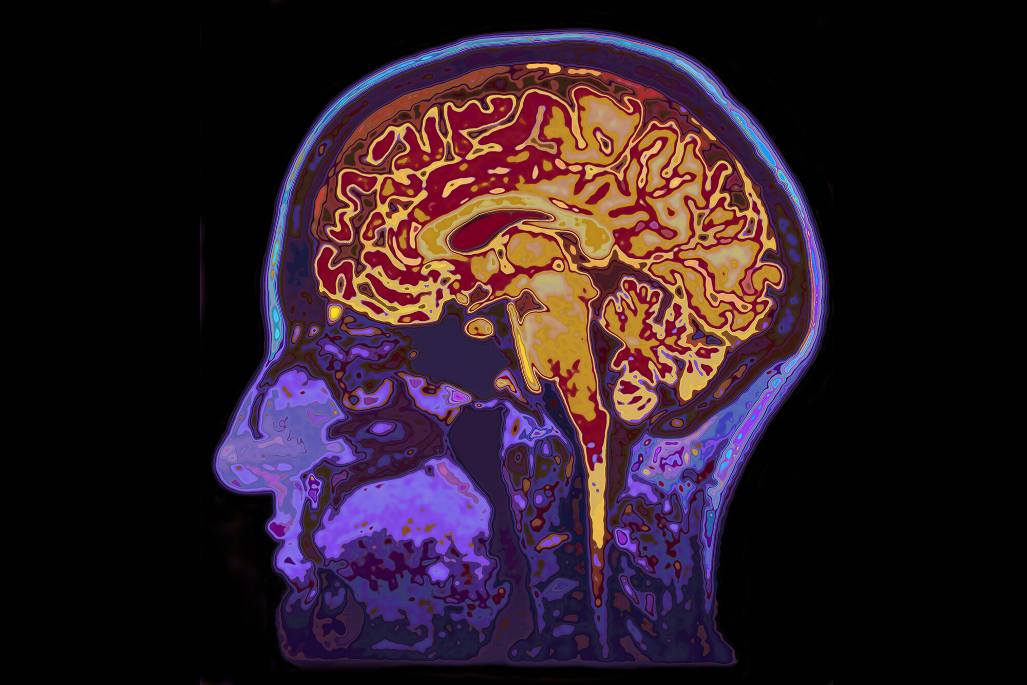 A brain scan highlighting brain activity.